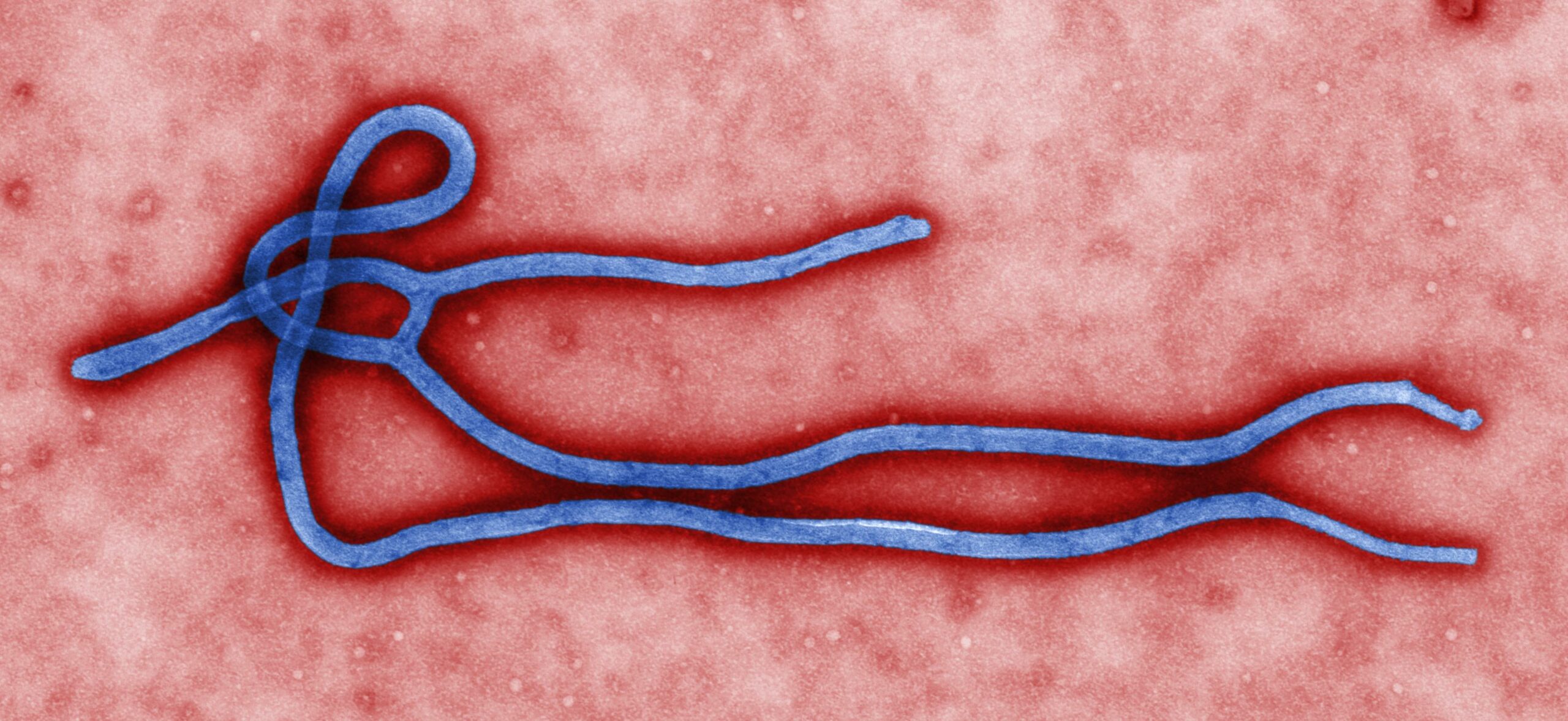 Une infirmière avait vaincu 2 fois Ebola, elle a été hospitalisée