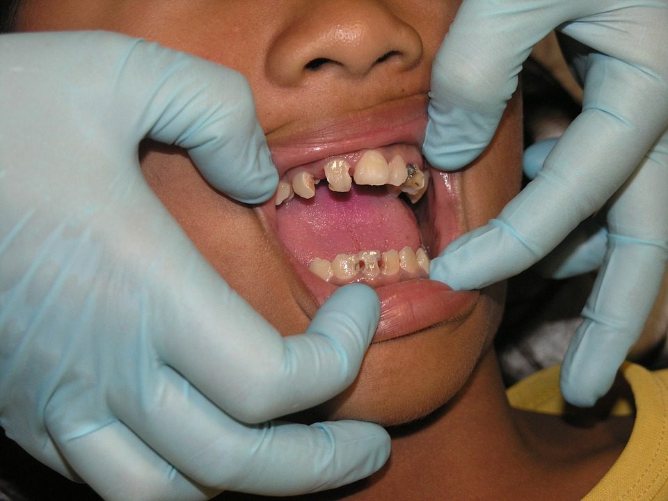 Dentition abimée
