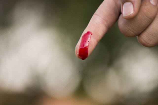 Doigt-en-sang-640x427 Ardèche : une épidémie de rougeole déclarée avec pour foyer infectieux la commune d'Ardoix