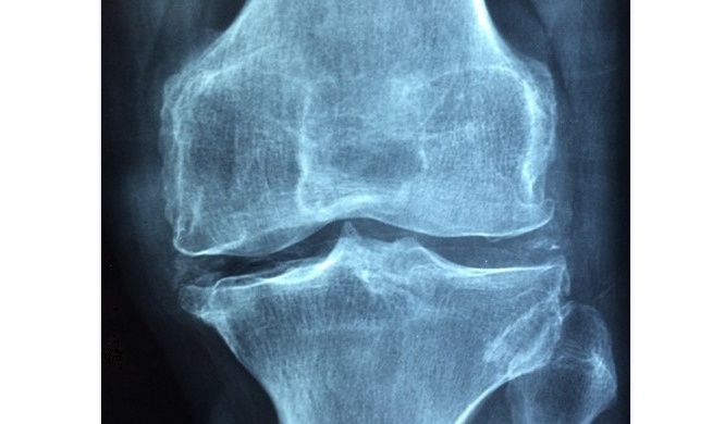 Arthrose : un implant 3D capable de régénérer le cartilage du genou
