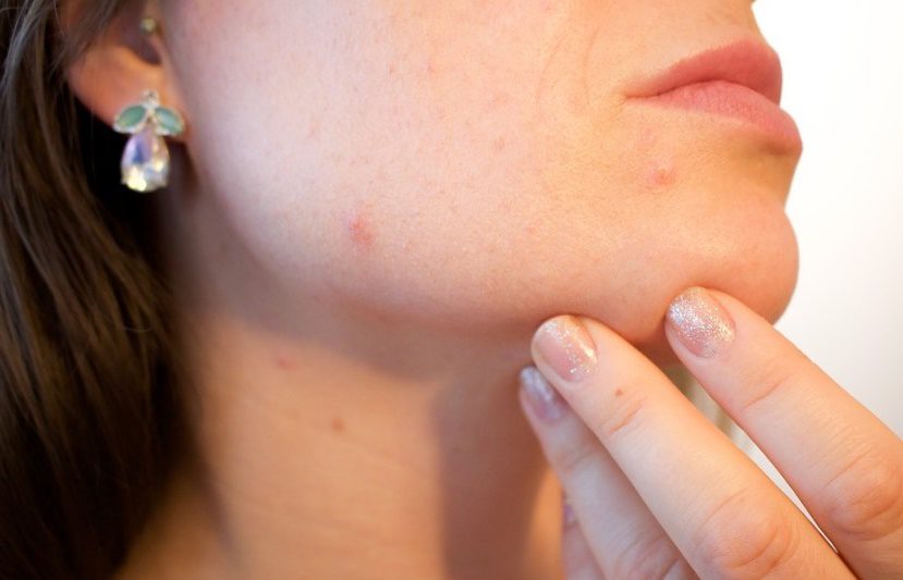 Instagram : une jeune femme, âgée de 22 ans, témoigne de sa victoire sur une acné sévère et sensibilise les internautes