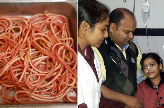 Inde : opération chirurgicale réussie pour retirer 150 vers des intestins d’une jeune patiente de 22 ans